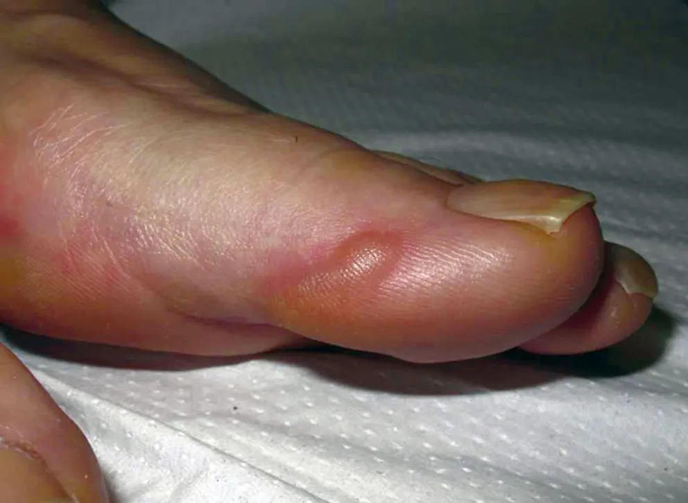 Dermatosis del deporte
